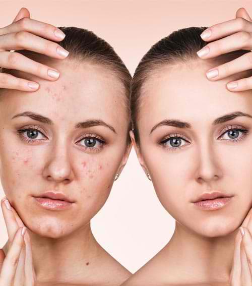 Acne treatment