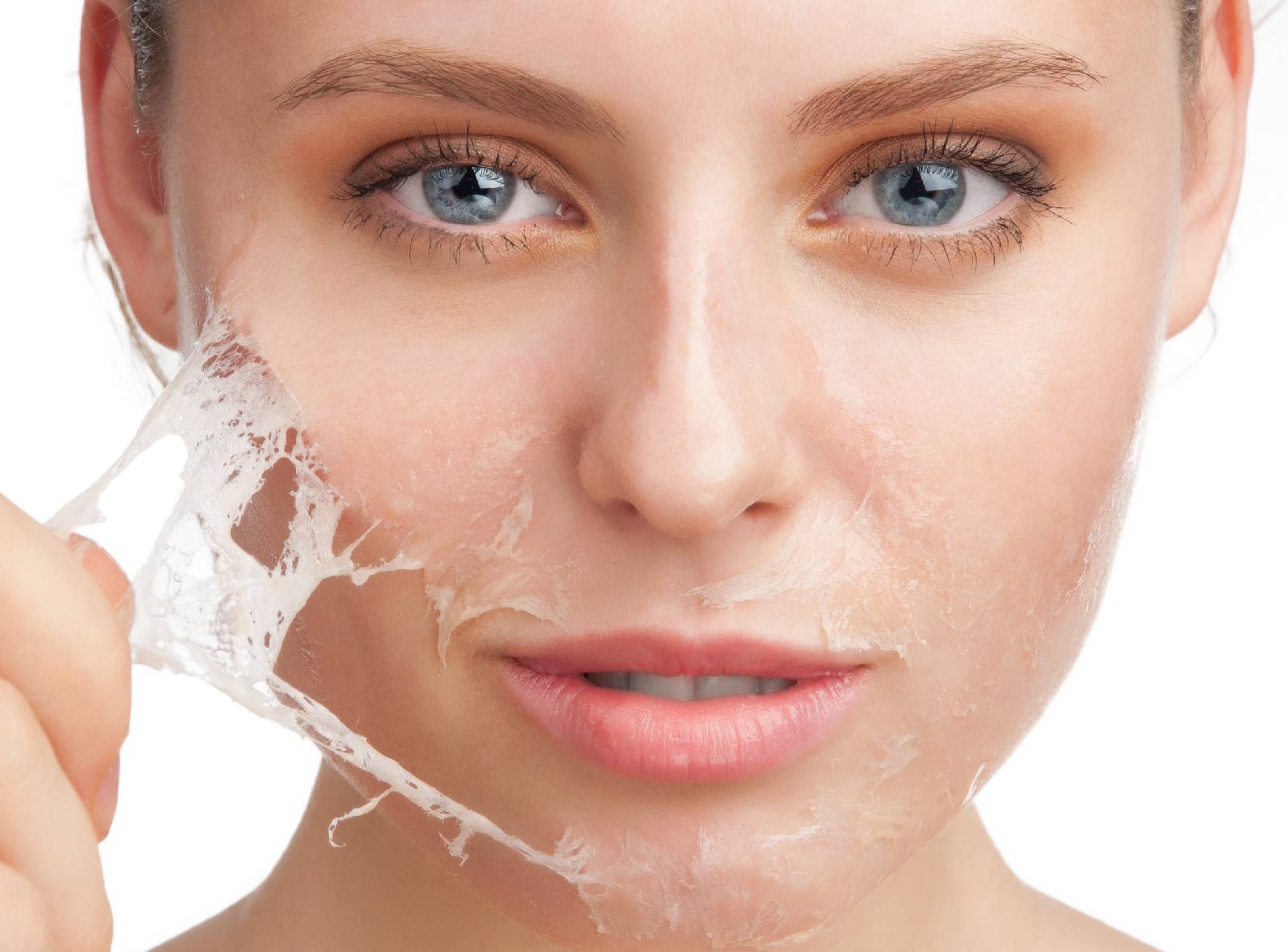 Chemical peels