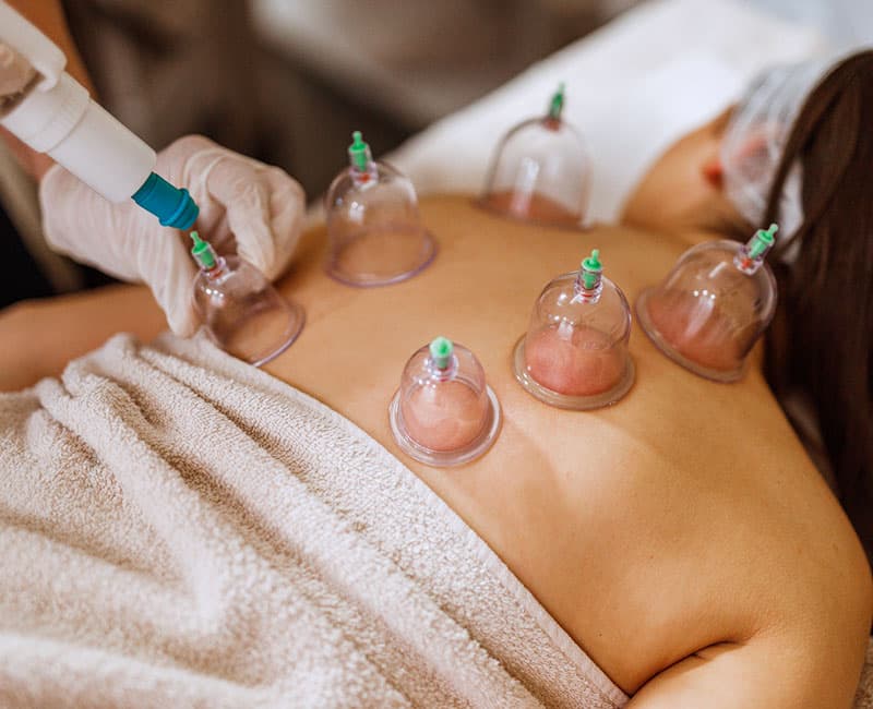 Hijama (cupping)