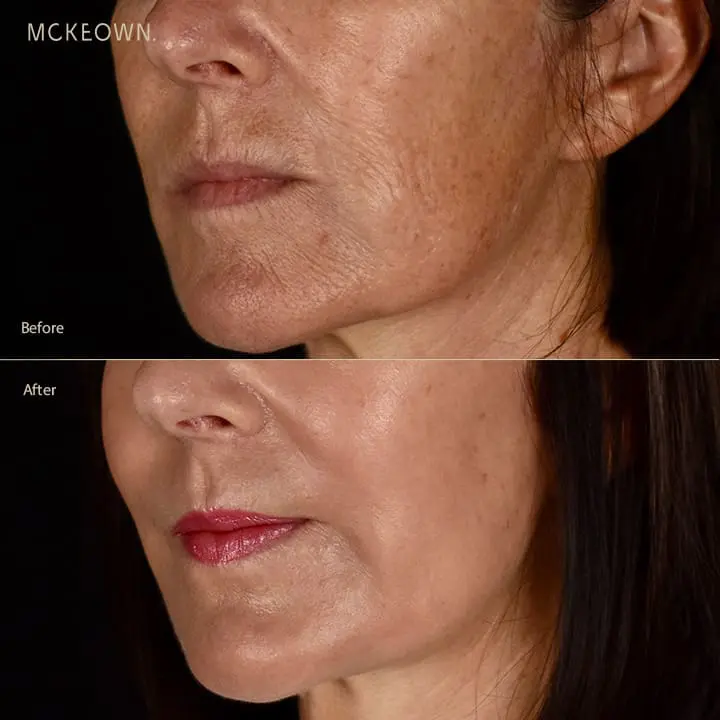 Laser skin rejuvenation