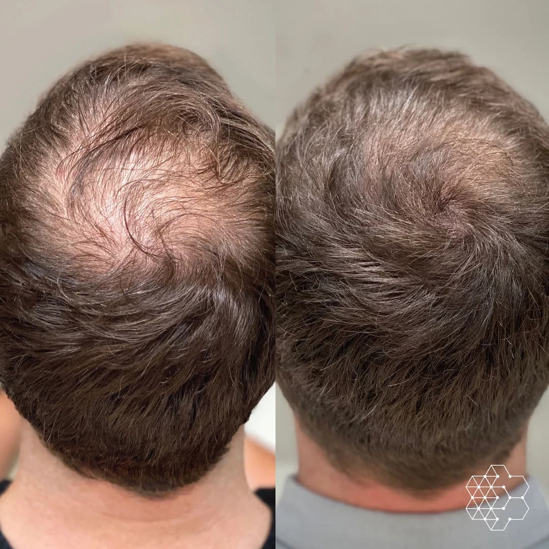 PRP for hair